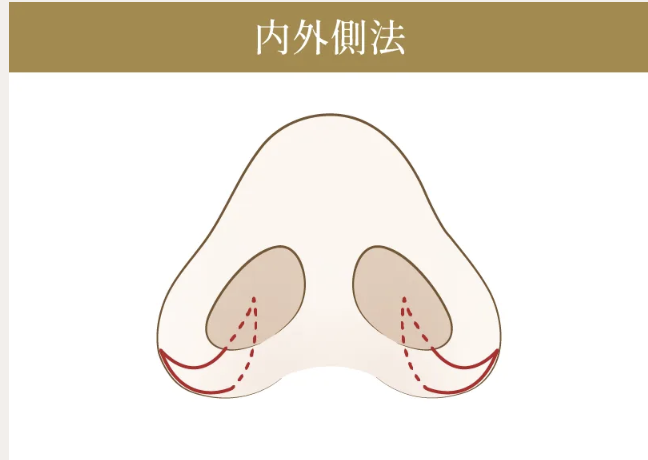 小鼻縮小(鼻翼縮小)の施術方法③