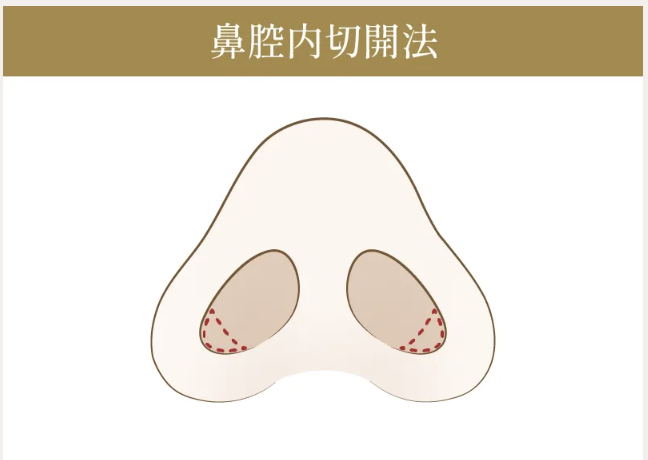 小鼻縮小(鼻翼縮小)の施術方法④