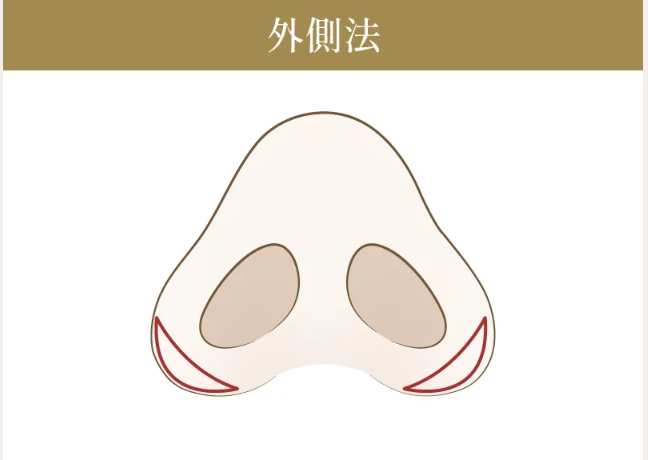 小鼻縮小(鼻翼縮小)の施術方法②
