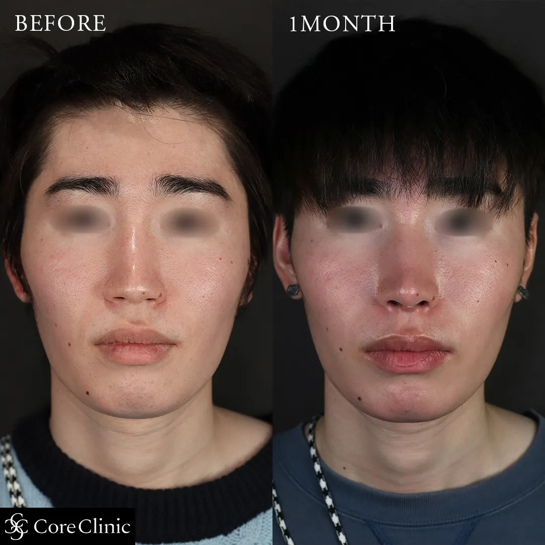 鼻先ベーシック（鼻尖形成＋耳介軟骨移植）の症例の症例写真1