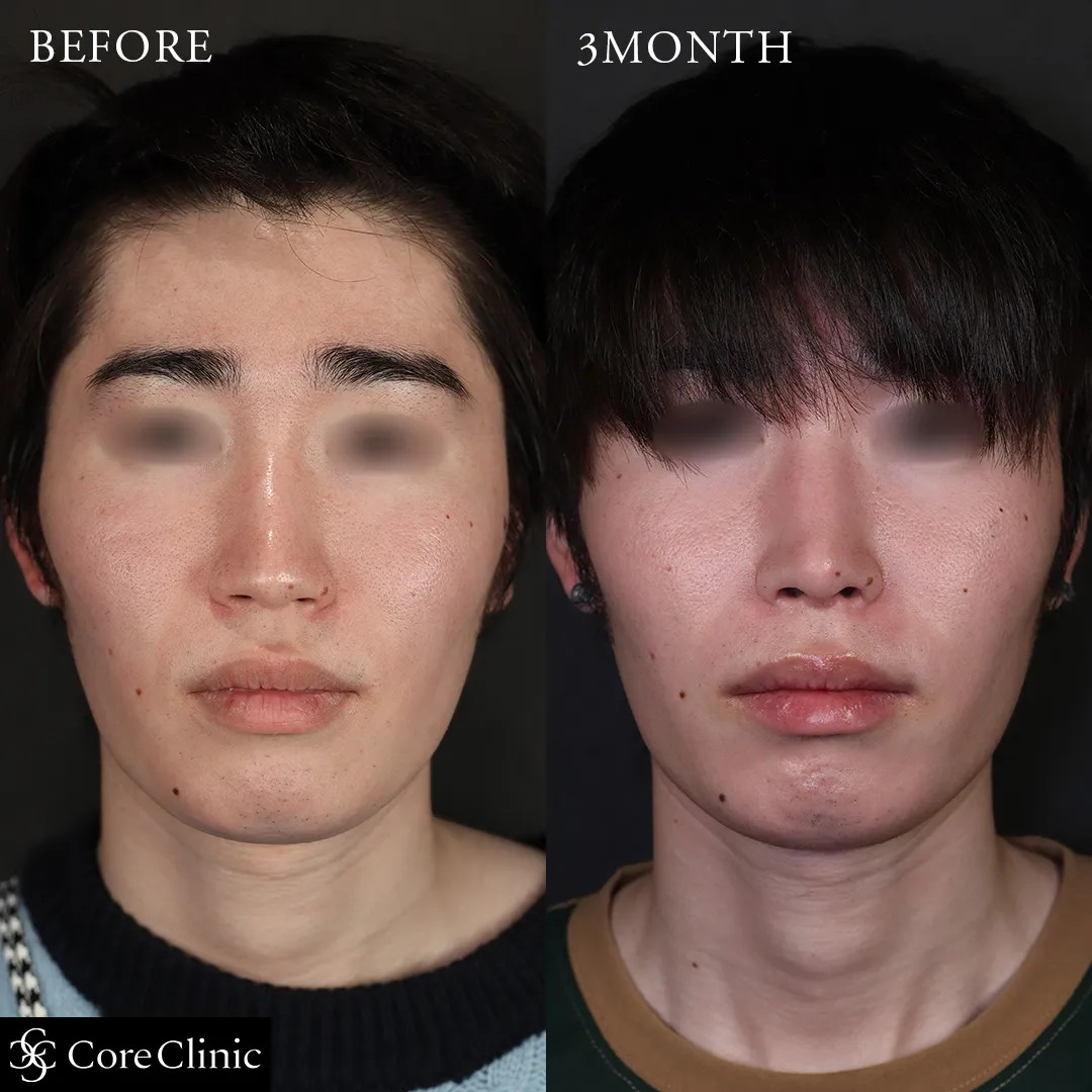 鼻先ベーシック（鼻尖形成＋耳介軟骨移植）の症例の症例写真3