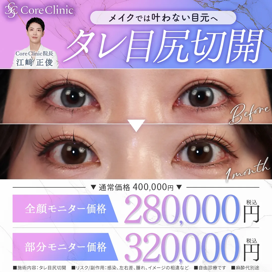 8月キャンペーンタレ目尻切開