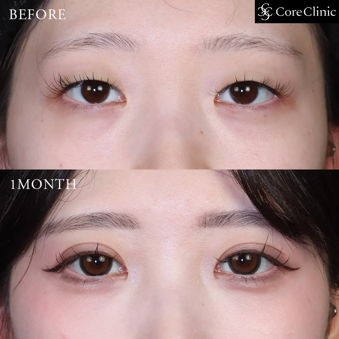 自然癒着法・目頭切開の術後1か月の正面の症例