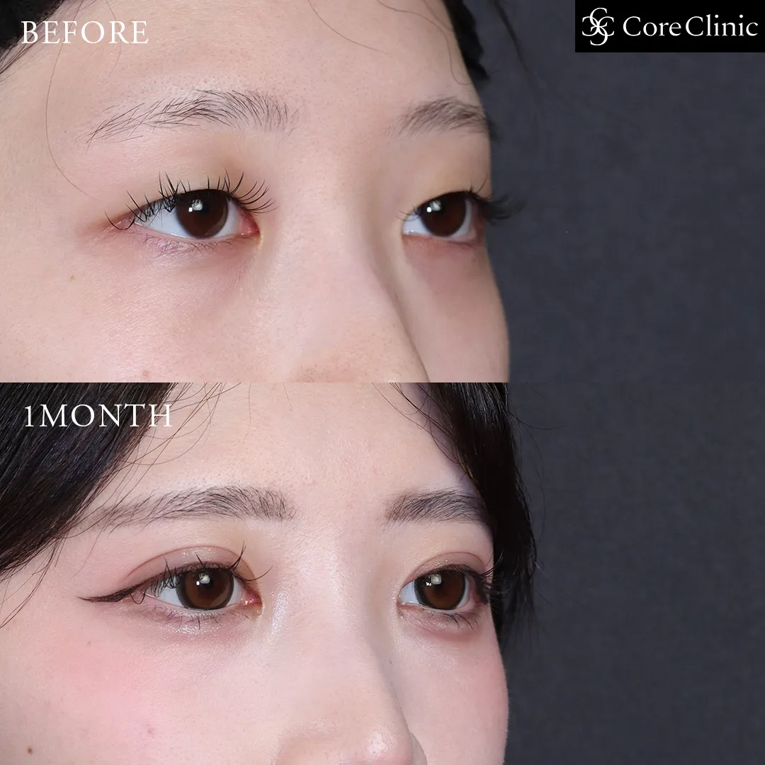 自然癒着法・目頭切開の術後1か月の右斜めの症例